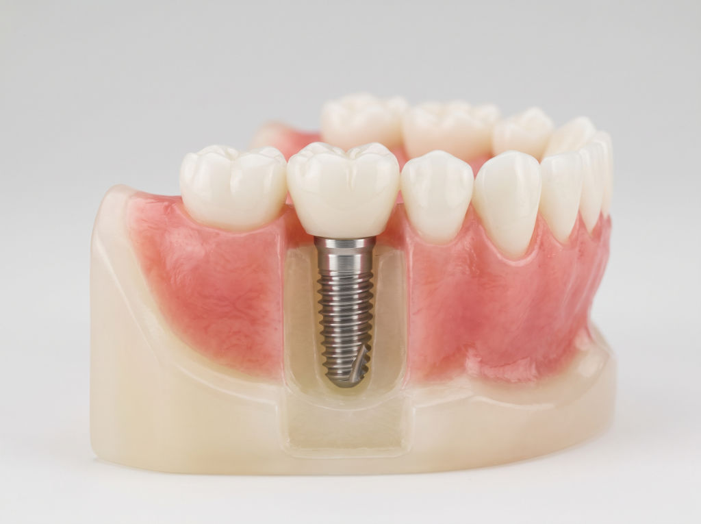 Implantat mit Krone